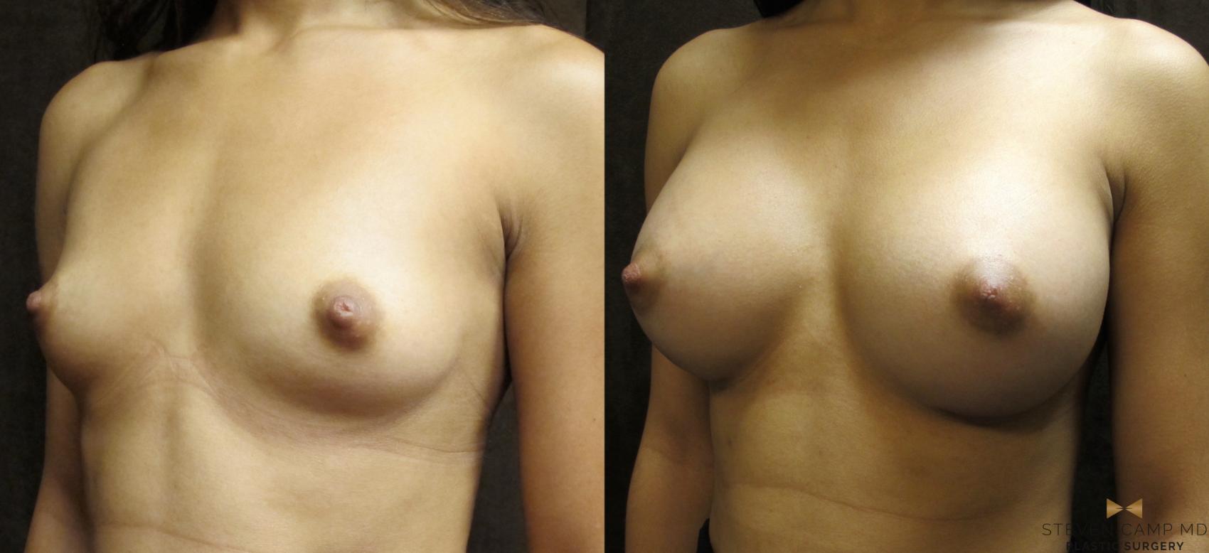Before & After Breast Augmentation Case 25 View #3 View in Fort Worth, Texas