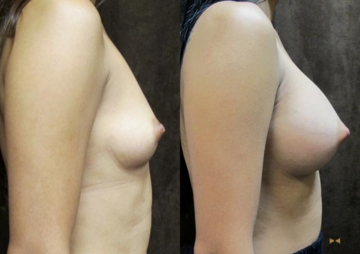 Before & After Breast Augmentation Case 25 View #4 View in Fort Worth, Texas