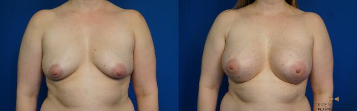 Before & After Breast Augmentation Case 252 View #1 View in Fort Worth & Arlington, Texas