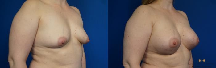 Before & After Breast Augmentation Case 252 View #2 View in Fort Worth & Arlington, Texas