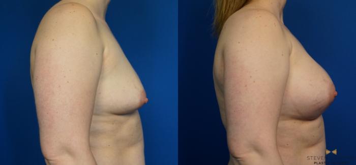 Before & After Breast Augmentation Case 252 View #3 View in Fort Worth & Arlington, Texas