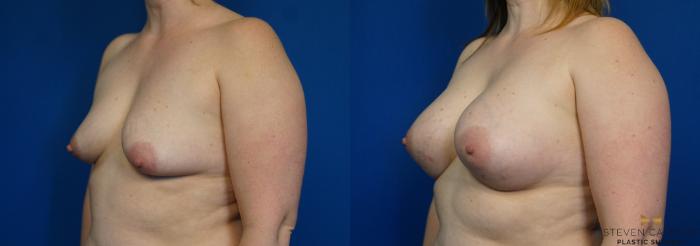 Before & After Breast Augmentation Case 252 View #4 View in Fort Worth & Arlington, Texas