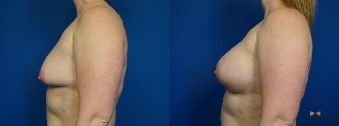Before & After Breast Augmentation Case 252 View #5 View in Fort Worth & Arlington, Texas