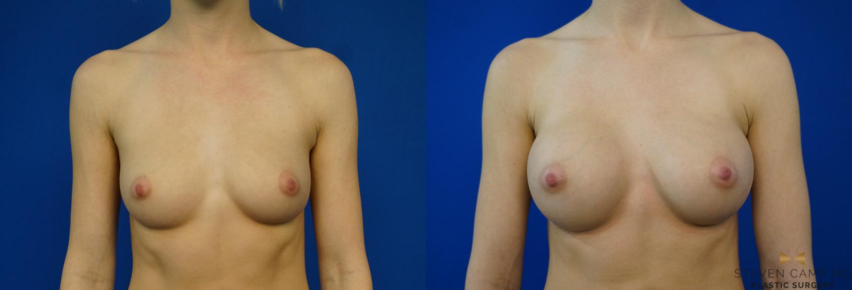 Before & After Breast Augmentation Case 257 View #1 View in Fort Worth & Arlington, Texas