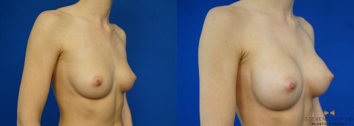 Before & After Breast Augmentation Case 257 View #2 View in Fort Worth, Texas
