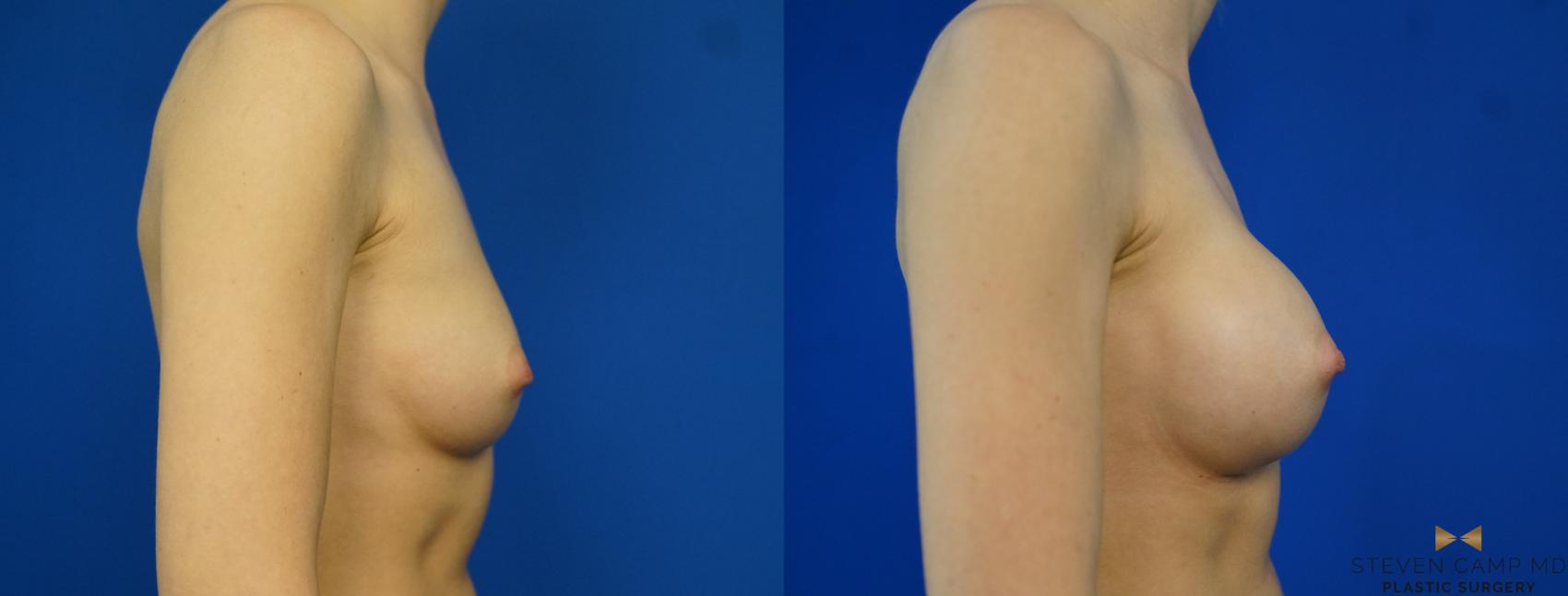 Before & After Breast Augmentation Case 257 View #3 View in Fort Worth & Arlington, Texas