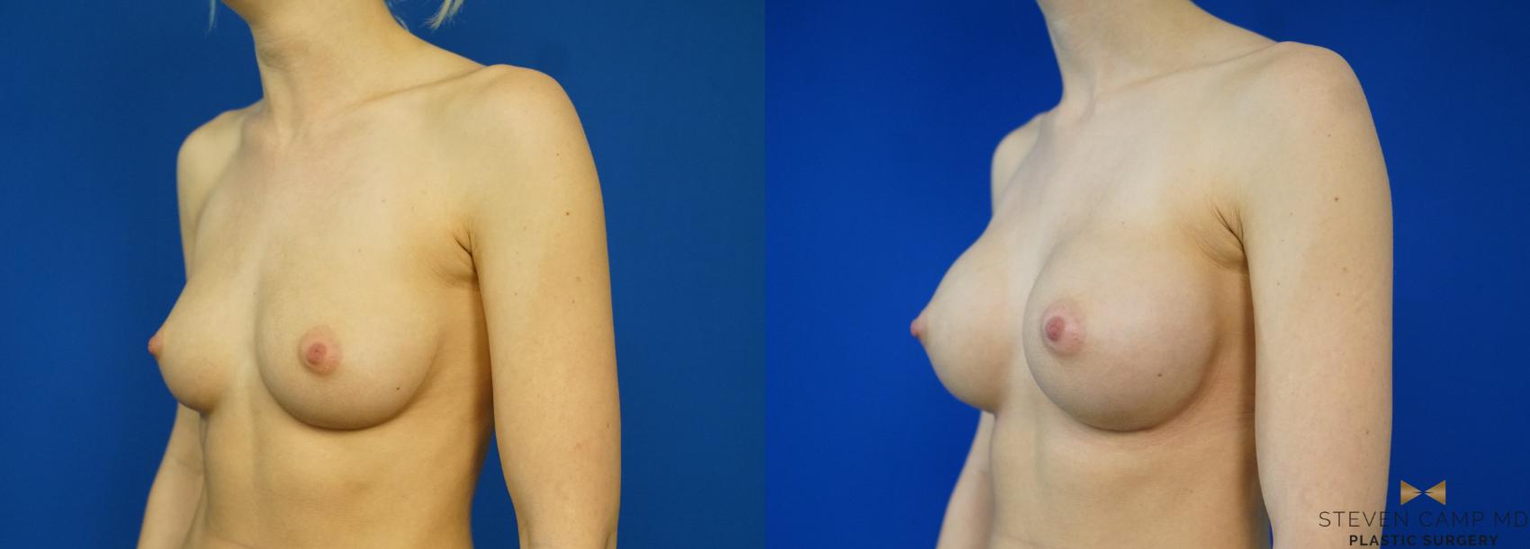 Before & After Breast Augmentation Case 257 View #4 View in Fort Worth & Arlington, Texas