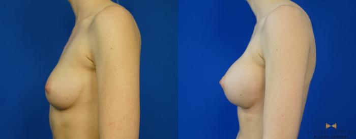Before & After Breast Augmentation Case 257 View #5 View in Fort Worth, Texas