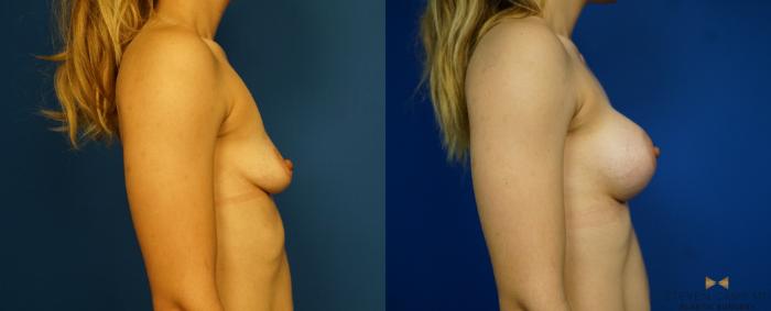 Before & After Breast Augmentation Case 259 View #1 View in Fort Worth & Arlington, Texas
