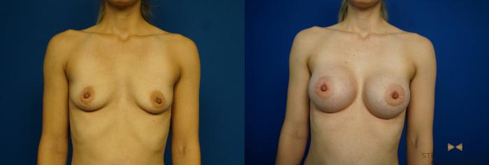 Before & After Breast Augmentation Case 259 View #2 View in Fort Worth & Arlington, Texas