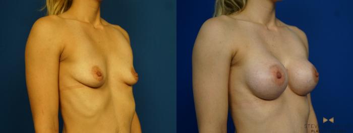 Before & After Breast Augmentation Case 259 View #3 View in Fort Worth & Arlington, Texas