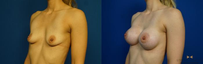 Before & After Breast Augmentation Case 259 View #4 View in Fort Worth & Arlington, Texas