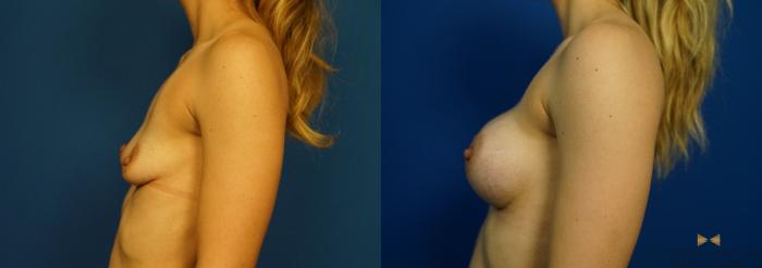 Before & After Breast Augmentation Case 259 View #5 View in Fort Worth & Arlington, Texas