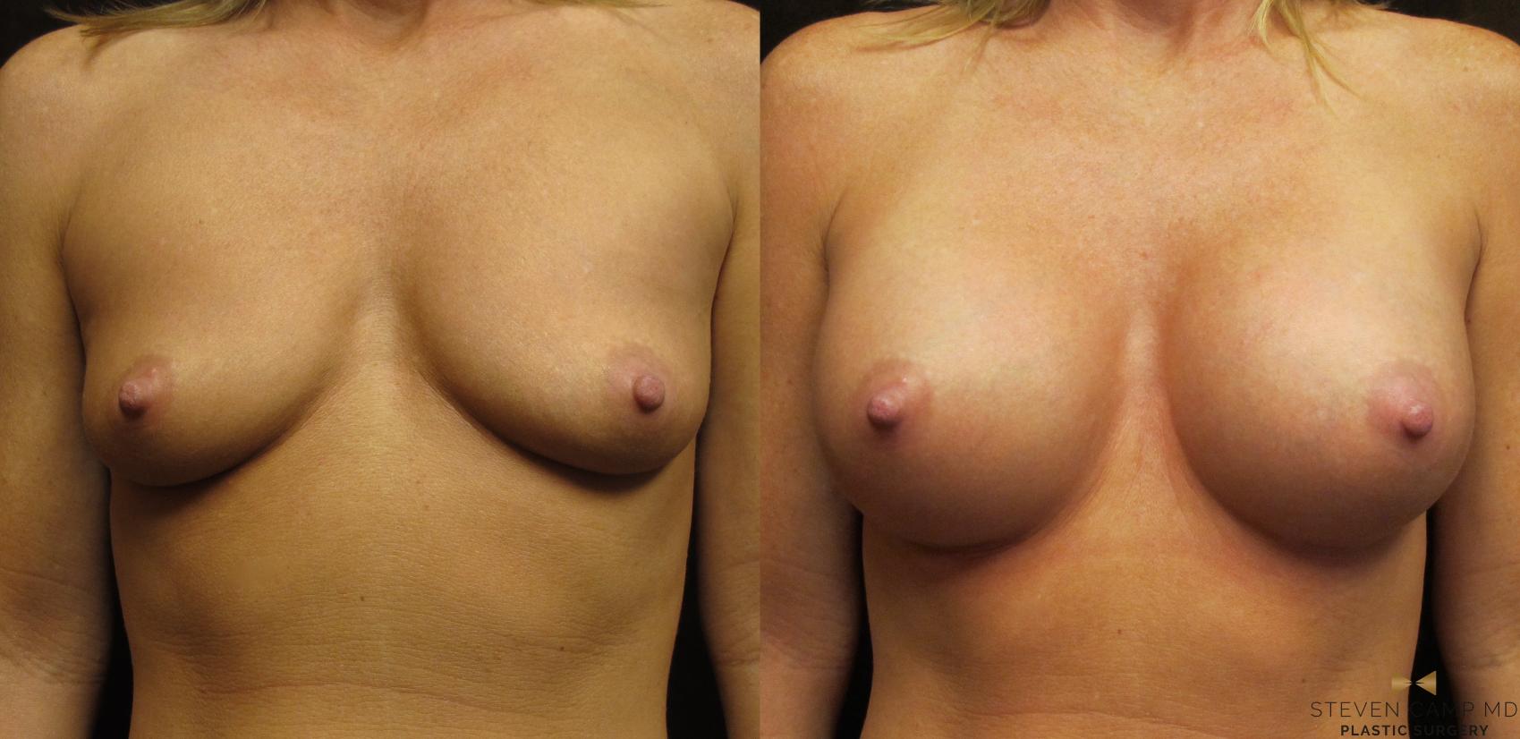 Before & After Breast Augmentation Case 26 View #1 View in Fort Worth & Arlington, Texas