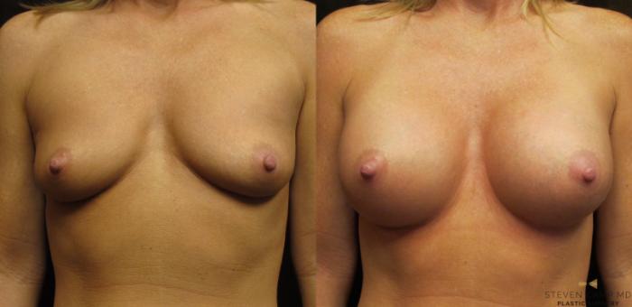 Before & After Breast Augmentation Case 26 View #1 View in Fort Worth, Texas