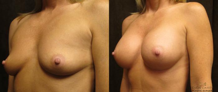Before & After Breast Augmentation Case 26 View #2 View in Fort Worth, Texas