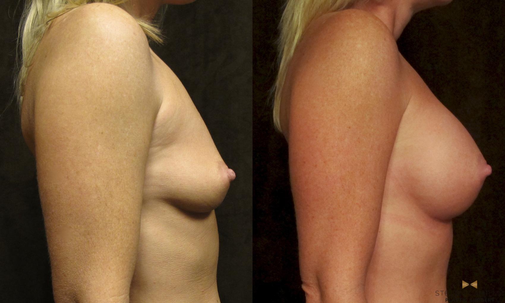 Before & After Breast Augmentation Case 26 View #3 View in Fort Worth, Texas