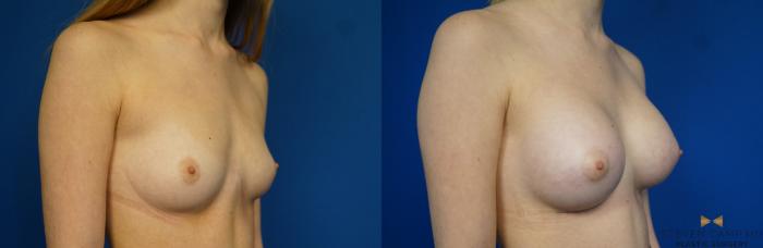 Before & After Breast Augmentation Case 267 View #1 View in Fort Worth & Arlington, Texas
