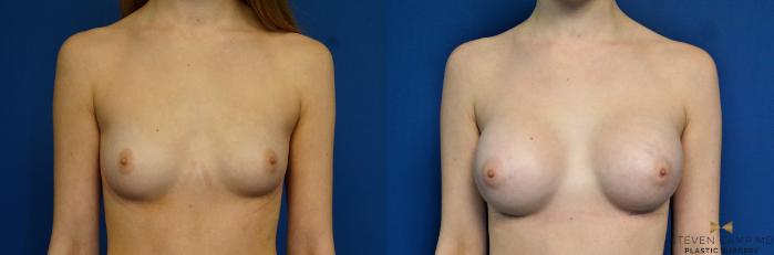 Before & After Breast Augmentation Case 267 View #2 View in Fort Worth & Arlington, Texas
