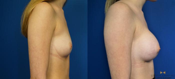 Before & After Breast Augmentation Case 267 View #3 View in Fort Worth & Arlington, Texas