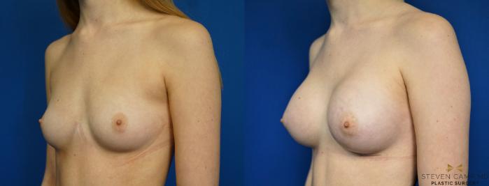 Before & After Breast Augmentation Case 267 View #4 View in Fort Worth & Arlington, Texas