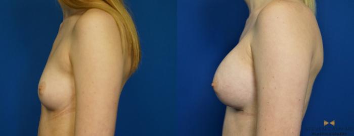Before & After Breast Augmentation Case 267 View #5 View in Fort Worth & Arlington, Texas
