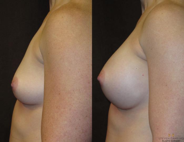 Before & After Breast Augmentation Case 27 View #3 View in Fort Worth, Texas