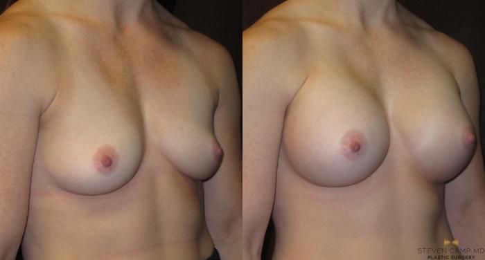 Before & After Breast Augmentation Case 27 View #4 View in Fort Worth, Texas