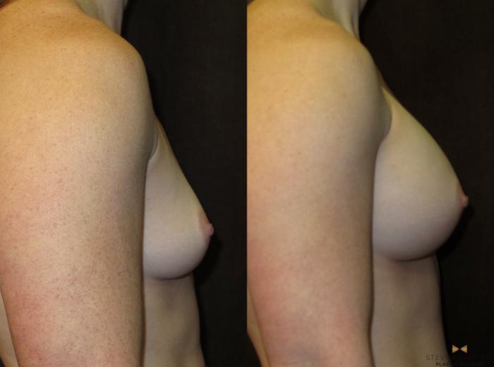 Before & After Breast Augmentation Case 27 View #5 View in Fort Worth, Texas