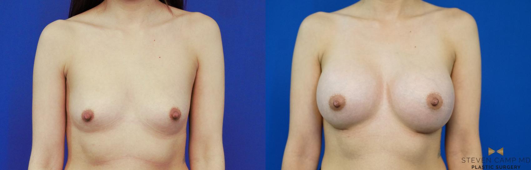 Before & After Breast Augmentation Case 277 View #1 View in Fort Worth & Arlington, Texas