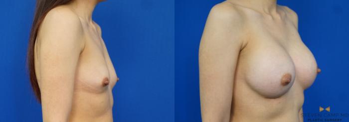 Before & After Breast Augmentation Case 277 View #2 View in Fort Worth & Arlington, Texas
