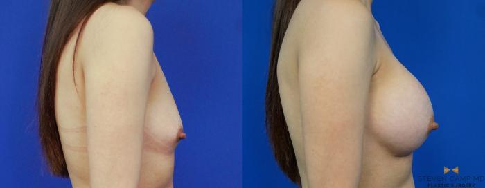 Before & After Breast Augmentation Case 277 View #3 View in Fort Worth & Arlington, Texas