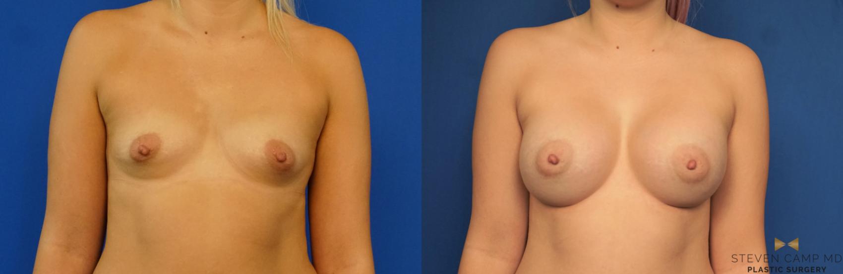 Before & After Breast Augmentation Case 279 View #1 View in Fort Worth & Arlington, Texas