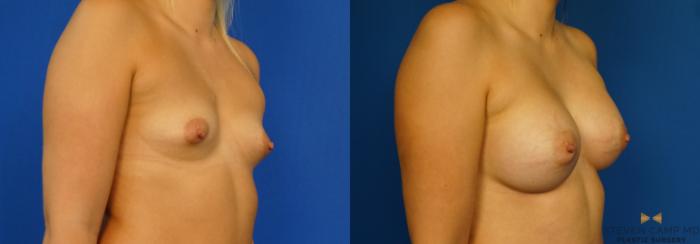 Before & After Breast Augmentation Case 279 View #2 View in Fort Worth, Texas
