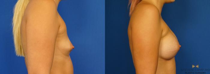 Before & After Breast Augmentation Case 279 View #3 View in Fort Worth, Texas