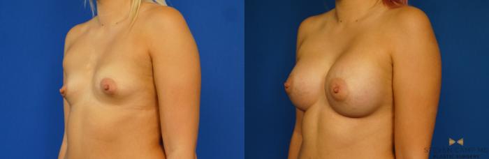 Before & After Breast Augmentation Case 279 View #4 View in Fort Worth, Texas
