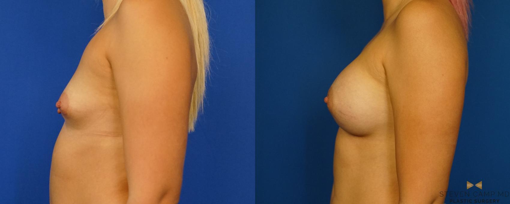 Before & After Breast Augmentation Case 279 View #5 View in Fort Worth & Arlington, Texas