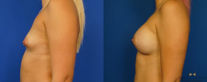 Before & After Breast Augmentation Case 279 View #5 View in Fort Worth, Texas