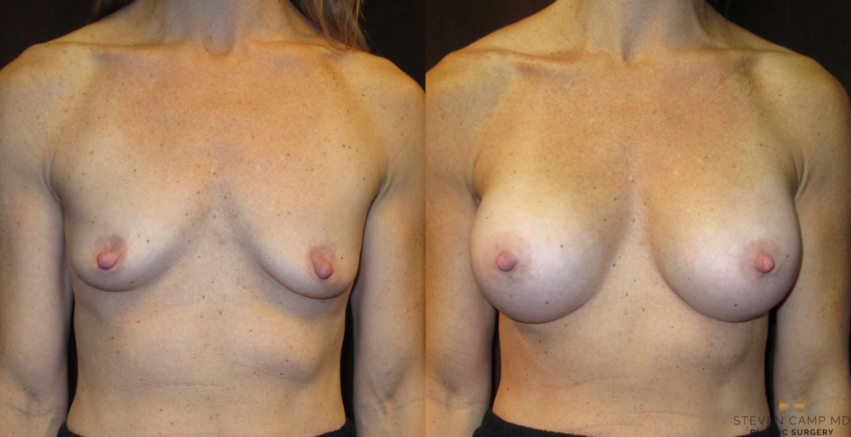 Before & After Case2910 by Steven Camp MD Plastic Surgery & Aesthetics, in Fort Worth