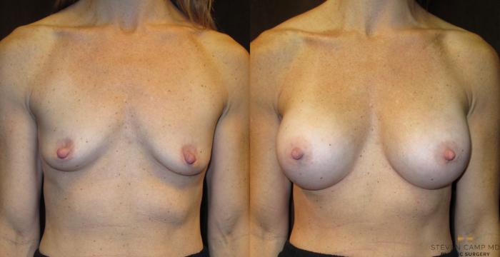 Before & After Breast Augmentation Case 28 View #1 View in Fort Worth, Texas