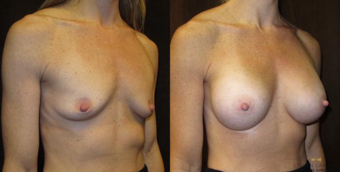 Before & After Breast Augmentation Case 28 View #2 View in Fort Worth & Arlington, Texas