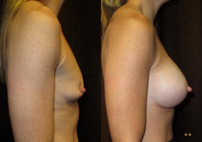 Before & After Breast Augmentation Case 28 View #3 View in Fort Worth & Arlington, Texas