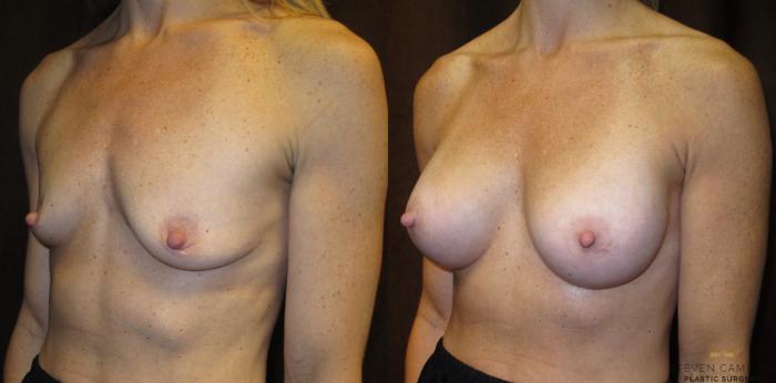 Before & After Breast Augmentation Case 28 View #4 View in Fort Worth, Texas