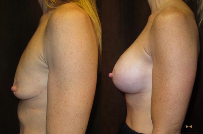 Before & After Breast Augmentation Case 28 View #5 View in Fort Worth & Arlington, Texas