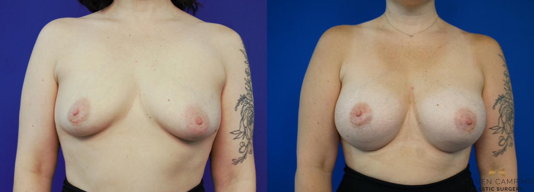 Before & After Breast Augmentation Case 282 View #1 View in Fort Worth, Texas