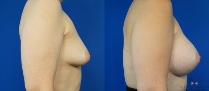 Before & After Breast Augmentation Case 282 View #3 View in Fort Worth, Texas