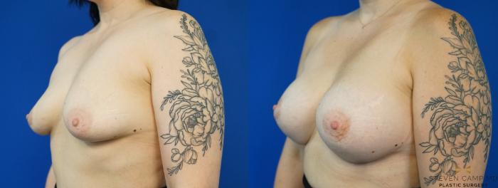 Before & After Breast Augmentation Case 282 View #4 View in Fort Worth, Texas