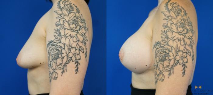 Before & After Breast Augmentation Case 282 View #5 View in Fort Worth, Texas