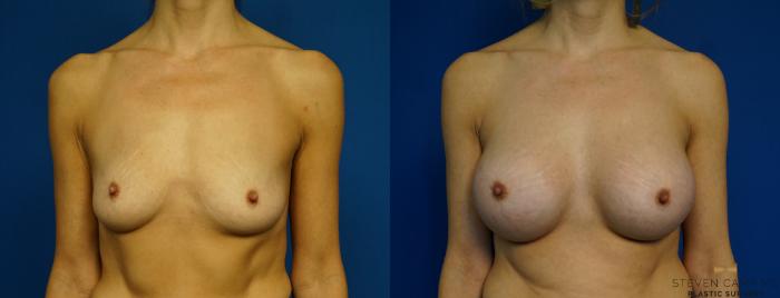 Before & After Breast Augmentation Case 283 View #1 View in Fort Worth & Arlington, Texas