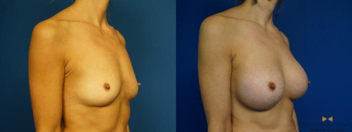 Before & After Breast Augmentation Case 283 View #2 View in Fort Worth & Arlington, Texas